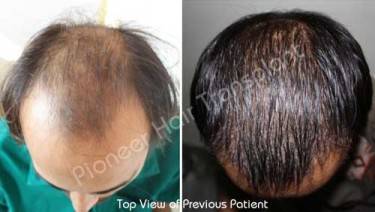 HAIR TRANSPLANT