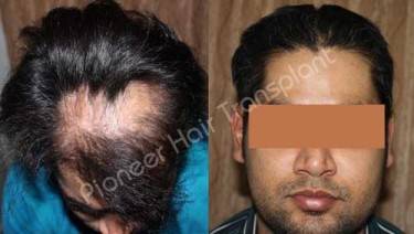HAIR TRANSPLANT