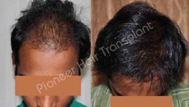 HAIR TRANSPLANT
