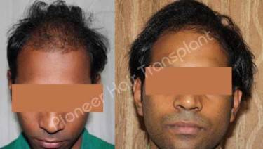 HAIR TRANSPLANT