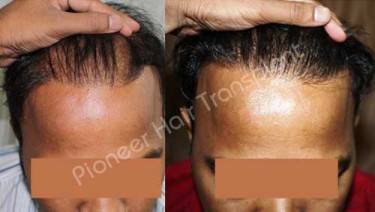 HAIR TRANSPLANT