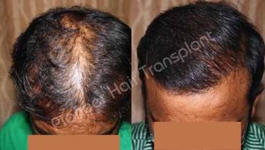 HAIR TRANSPLANT