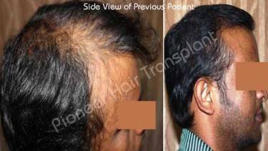HAIR TRANSPLANT