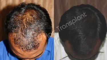 HAIR TRANSPLANT