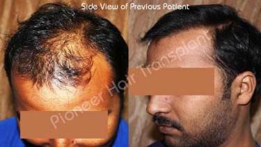 HAIR TRANSPLANT