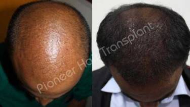 HAIR TRANSPLANT