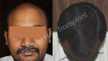 HAIR TRANSPLANT