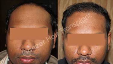 HAIR TRANSPLANT