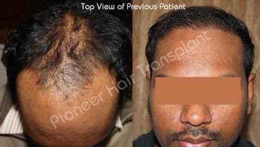 HAIR TRANSPLANT