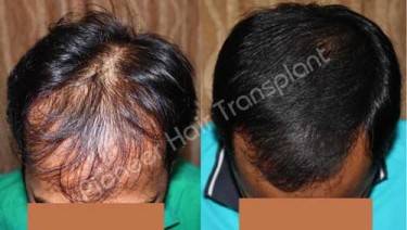 HAIR TRANSPLANT