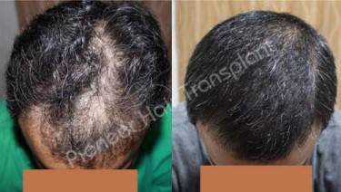 HAIR TRANSPLANT