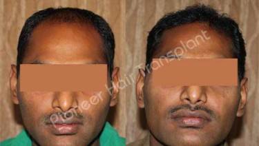 HAIR TRANSPLANT