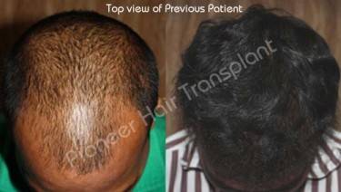 HAIR TRANSPLANT
