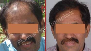 HAIR TRANSPLANT