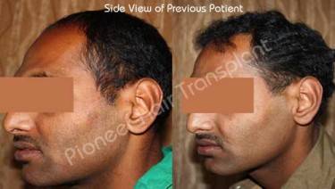 HAIR TRANSPLANT