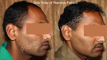 HAIR TRANSPLANT