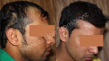 HAIR TRANSPLANT
