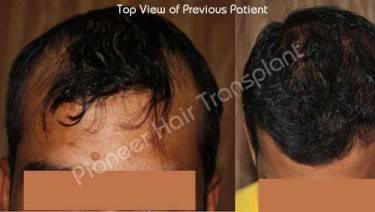 HAIR TRANSPLANT