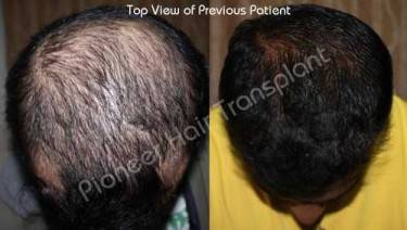 HAIR TRANSPLANT