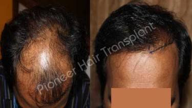 HAIR TRANSPLANT