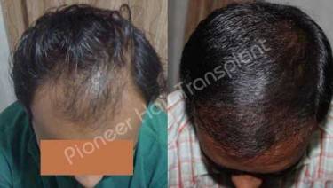 HAIR TRANSPLANT