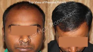HAIR TRANSPLANT