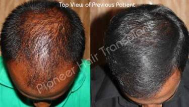 HAIR TRANSPLANT