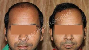 HAIR TRANSPLANT