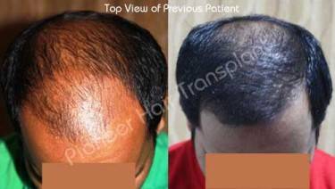 HAIR TRANSPLANT