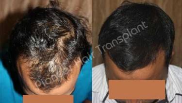 HAIR TRANSPLANT