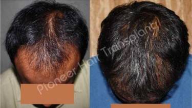 HAIR TRANSPLANT
