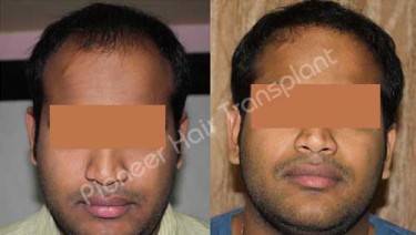 HAIR TRANSPLANT
