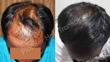 HAIR TRANSPLANT