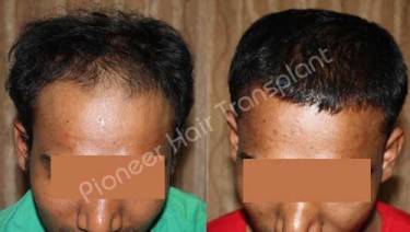 HAIR TRANSPLANT