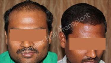 HAIR TRANSPLANT
