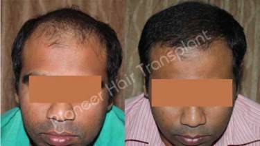 HAIR TRANSPLANT
