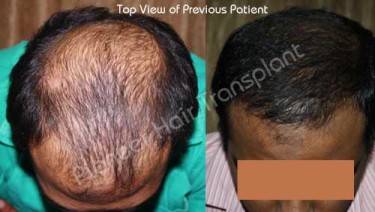 HAIR TRANSPLANT