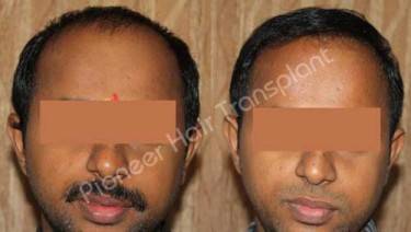 HAIR TRANSPLANT