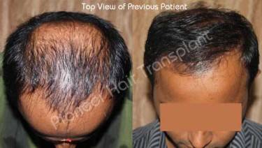 HAIR TRANSPLANT