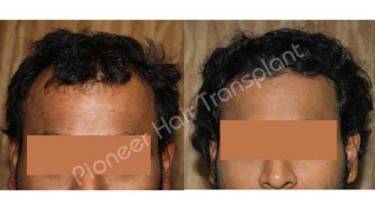 HAIR TRANSPLANT