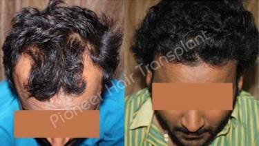 HAIR TRANSPLANT