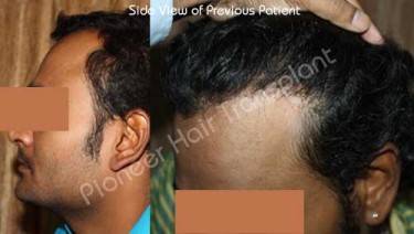HAIR TRANSPLANT