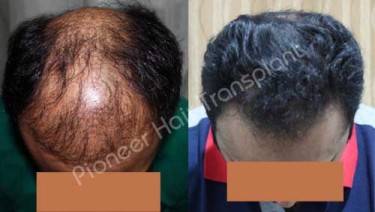 HAIR TRANSPLANT