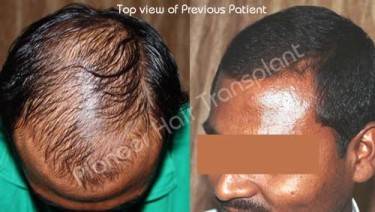 HAIR TRANSPLANT