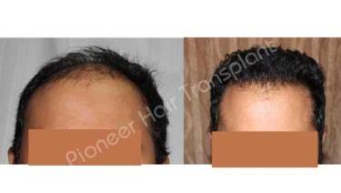 HAIR TRANSPLANT