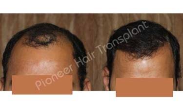 HAIR TRANSPLANT
