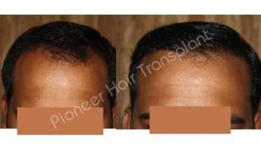 HAIR TRANSPLANT