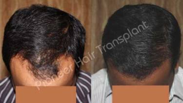 HAIR TRANSPLANT