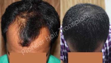 HAIR TRANSPLANT