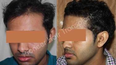 HAIR TRANSPLANT